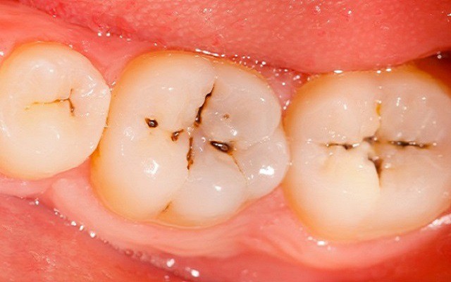 Cần làm gì để phòng ngừa sâu răng cho trẻ nhỏ? - Ảnh 2.