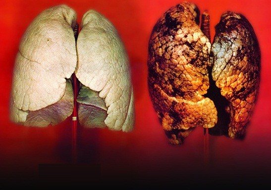 Thử nghiệm mới tìm ra phương pháp điều trị ung thư phổi hiệu quả - Ảnh 2.