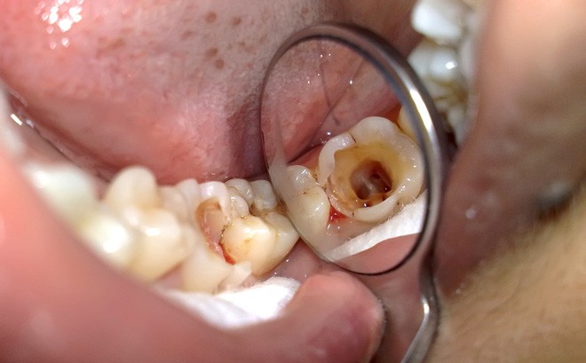 Các dấu hiệu viêm tuỷ răng thường gặp  - Ảnh 4.