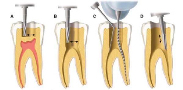 Phương pháp điều trị viêm tuỷ răng tại nhà  - Ảnh 5.