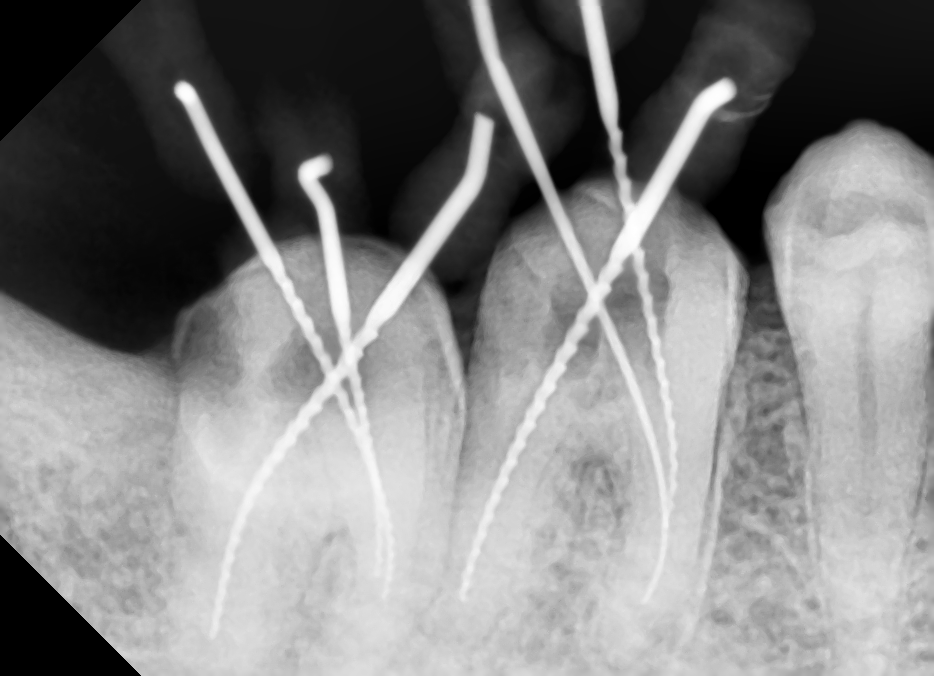 Phương pháp điều trị viêm tuỷ răng tại nhà  - Ảnh 1.