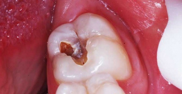 Viêm tuỷ răng là gì và các giai đoạn của bệnh? - Ảnh 5.