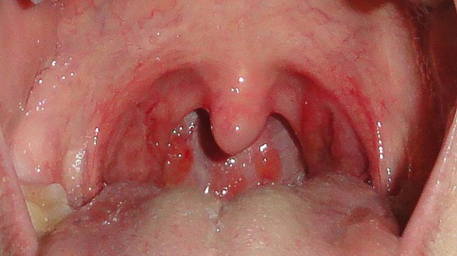 Đau vòm họng khi hít thở gây tức ngực Đau vòm họng