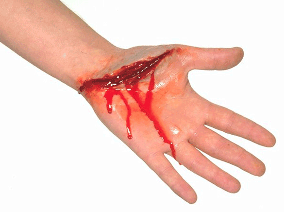 Khó cầm máu: Triệu chứng của bệnh máu khó đông - Ảnh 2.
