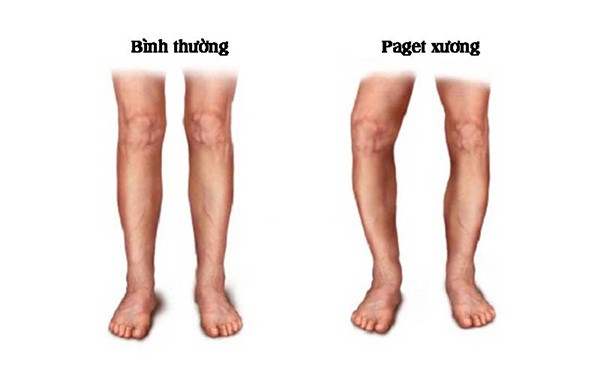 Bệnh Paget xương - nỗi ám ảnh của người trung niên - Ảnh 1.