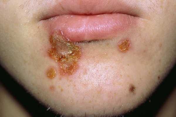 Bệnh chàm eczema là gì? - Ảnh 5.