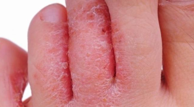 Bệnh chàm eczema là gì? - Ảnh 6.