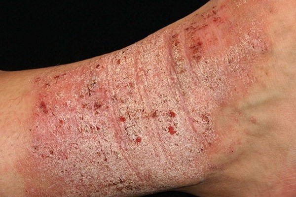 Bệnh chàm eczema là gì? - Ảnh 3.