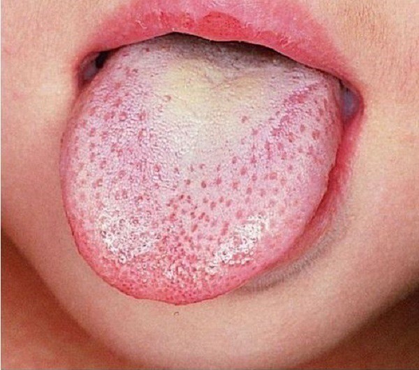 Tìm hiểu về triệu chứng viêm lưỡi di trú và các bệnh từ lưỡi