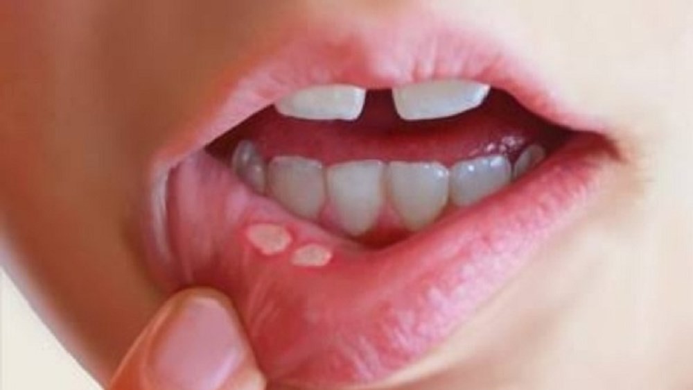 Nấm miệng là gì? Những điều cần biết về bệnh nấm miệng
