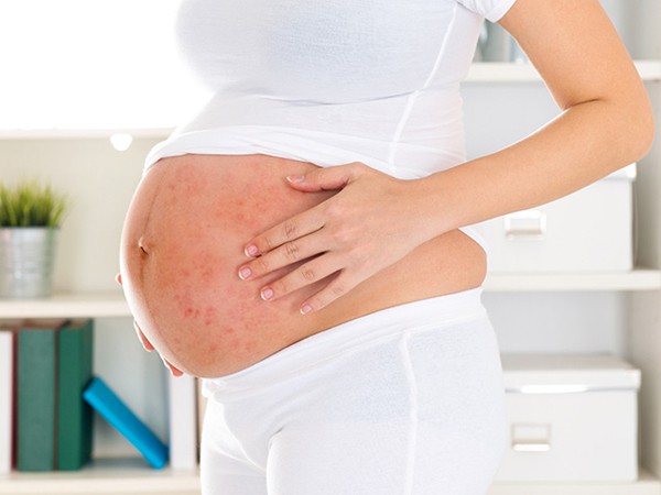 Muốn chữa viêm da cơ địa ở phụ nữ có thai tuyệt đối không được bỏ qua những phương pháp này - Ảnh 2.