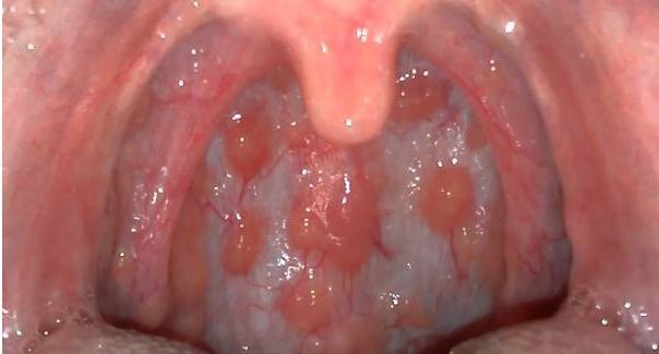 Dấu hiệu ung thư vòm họng dễ nhầm lẫn với dấu hiệu của bệnh cảm cúm - Ảnh 3.