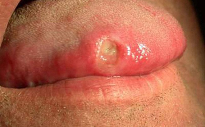 Triệu chứng bệnh giang mai ở miệng và cách điều trị - Ảnh 4.