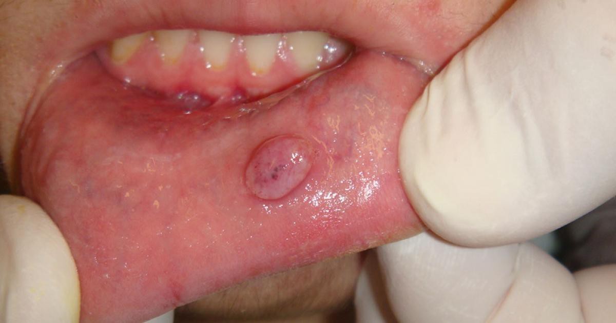 Triệu chứng bệnh giang mai ở miệng và cách điều trị - Ảnh 5.
