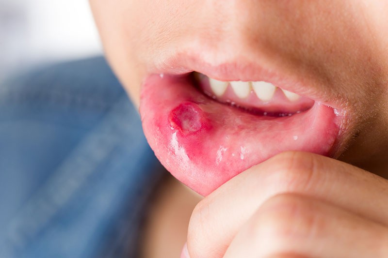 Triệu chứng bệnh giang mai ở miệng và cách điều trị - Ảnh 3.