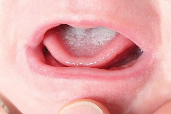 Bố mẹ đã hiểu đúng về bệnh tưa lưỡi ở trẻ chưa? - Ảnh 1.