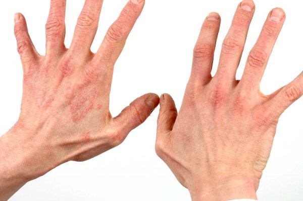 Bệnh viêm da tiếp xúc là gì? Nguyên nhân và cách phòng tránh căn bệnh ngoài da thường gặp - Ảnh 3.