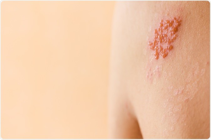 Bệnh viêm da tiếp xúc là gì? Nguyên nhân và cách phòng tránh căn bệnh ngoài da thường gặp - Ảnh 2.