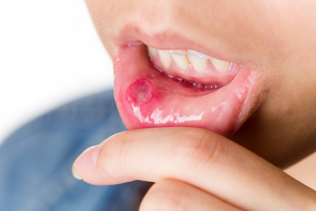 Nhiệt miệng là gì? Triệu chứng, nguyên nhân và cách điều trị