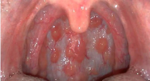 Viêm họng hạt là gì? Triệu chứng, nguyên nhân và cách điều trị