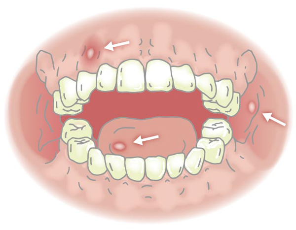 Nhiệt miệng là gì? Triệu chứng, nguyên nhân và cách điều trị