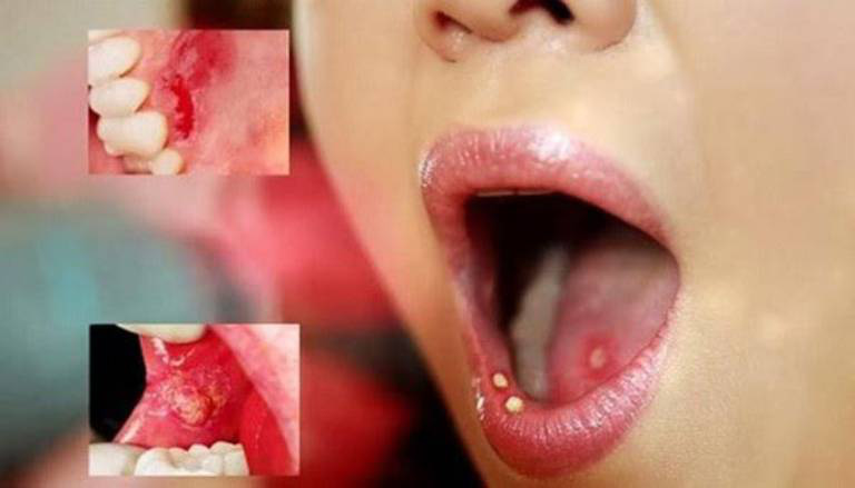Triệu chứng bệnh giang mai ở miệng và cách điều trị - Ảnh 7