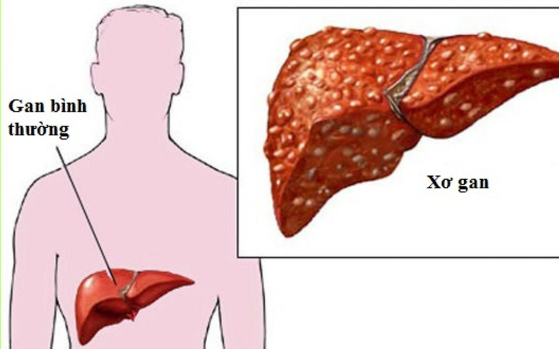 Những phương pháp điều trị xơ gan tại nhà không phải ai cũng biết