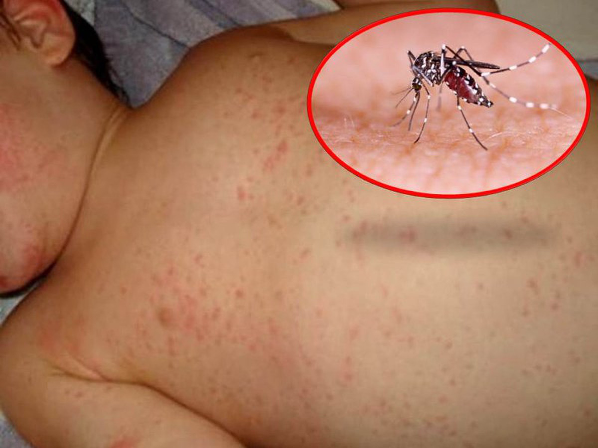 muỗi đốt bao lâu thì bị sốt xuất huyết