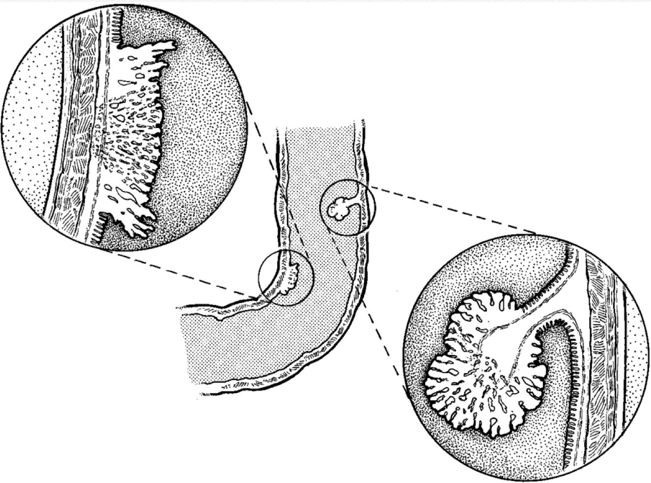 Bệnh polyp đại trực tràng là gì Những điều cần biết về polyp đại trực tràng 3