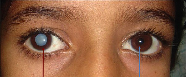 Ung thư mắt là gì? Nguyên nhân, dấu hiệu và cách điều trị bệnh - Ảnh 2.
