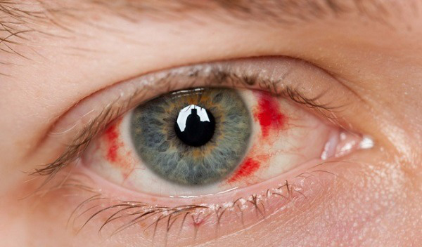 Ung thư mắt là gì? Nguyên nhân, dấu hiệu và cách điều trị bệnh - Ảnh 3.