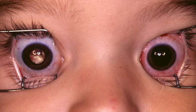 Ung thư mắt là gì? Nguyên nhân, dấu hiệu và cách điều trị bệnh - Ảnh 4.