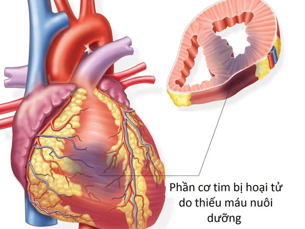 Thiếu máu cơ tim là gì Dấu hiệu, nguyên nhân và cách điều trị 1