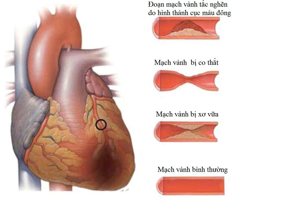 Thiếu máu cơ tim là gì Dấu hiệu, nguyên nhân và cách điều trị 3