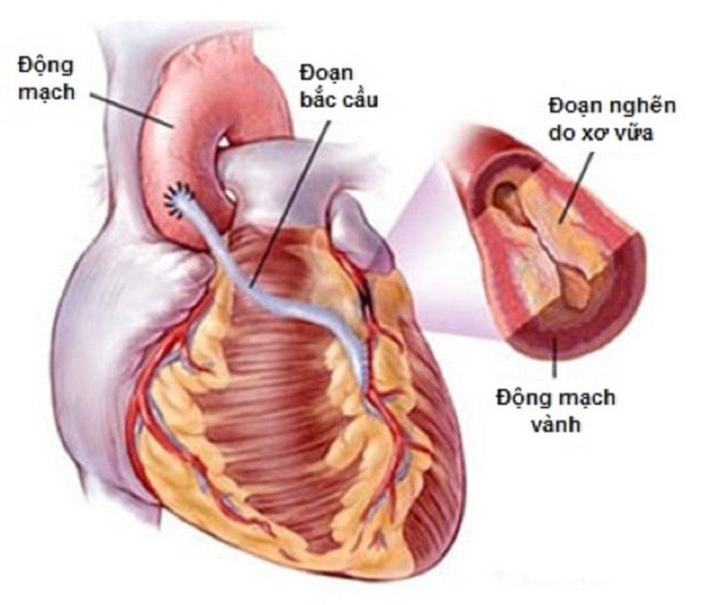 Thiếu máu cơ tim là gì Dấu hiệu, nguyên nhân và cách điều trị 4
