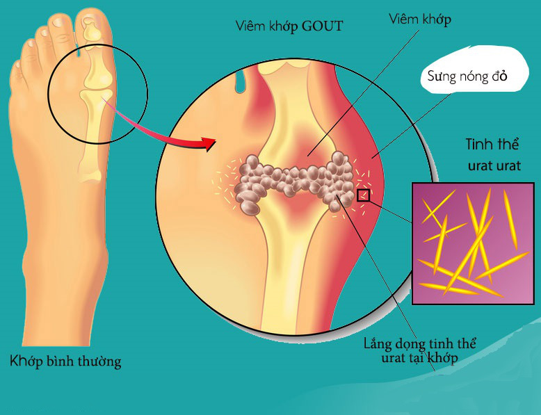 Bệnh giả Gout là gì và những điều cần biết về bệnh giả Gout-11