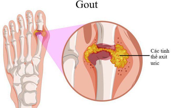 Bệnh giả Gout là gì và những điều cần biết về bệnh giả Gout-7