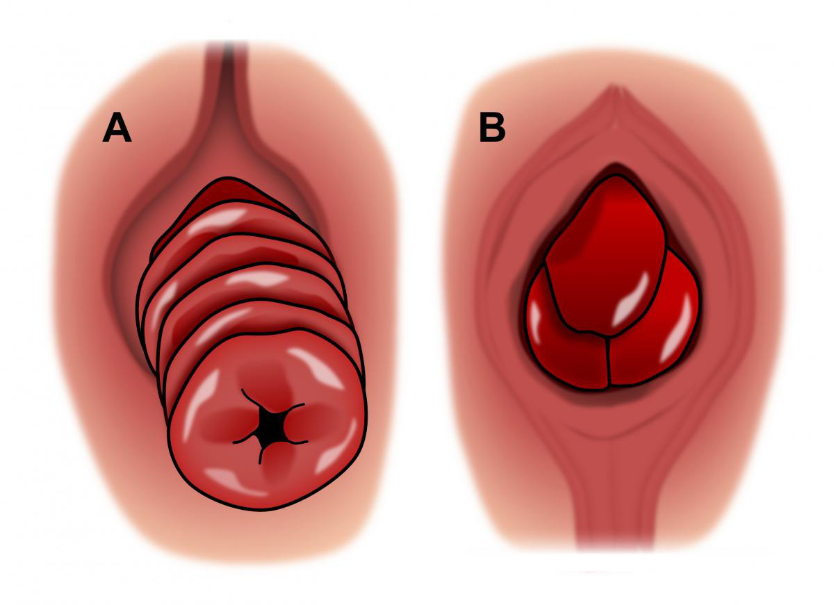 rectalprolapse_vs_hemorrhoid