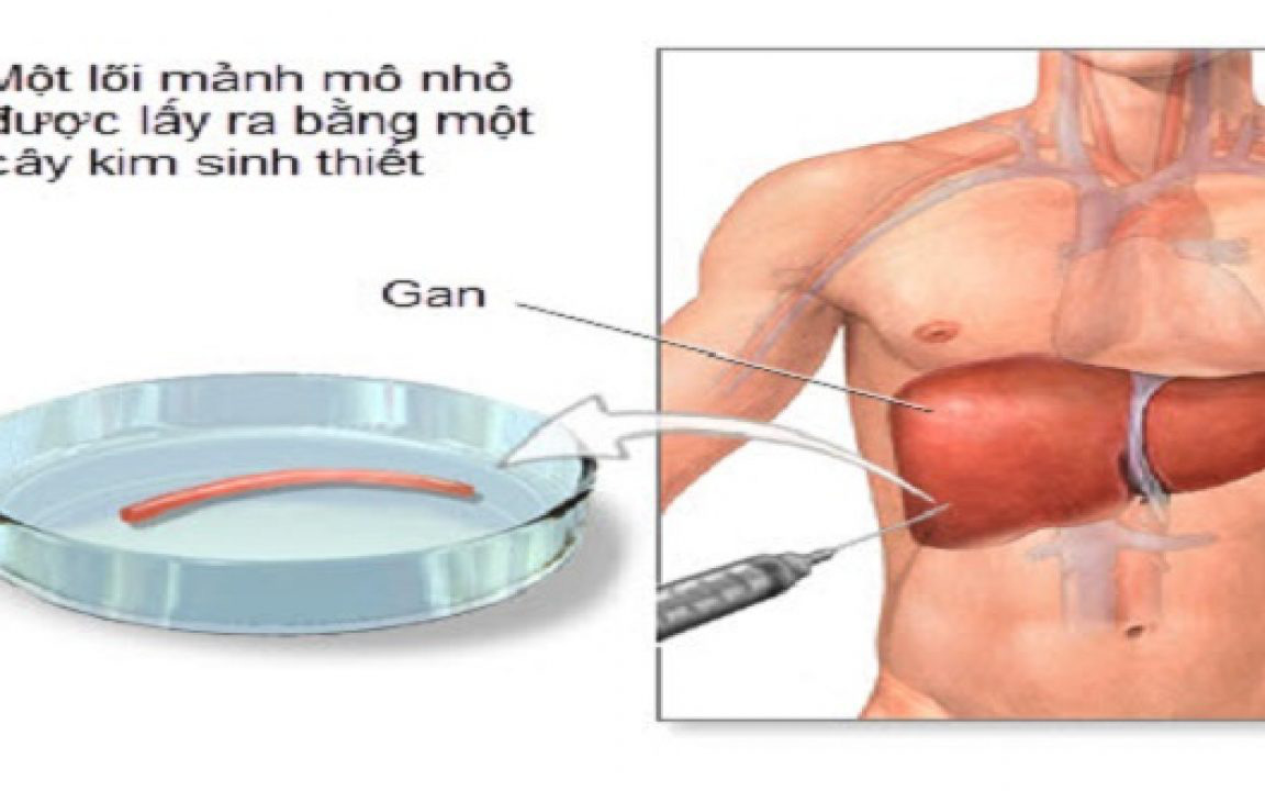 Tìm hiểu chung về phương pháp sinh thiết gan