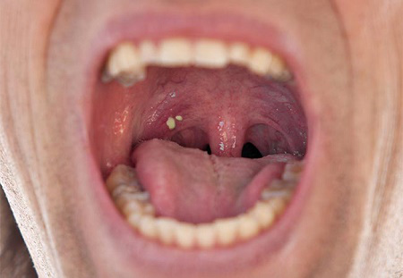 ung thư vòm họng và viêm họng