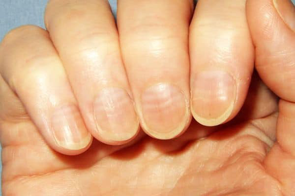 Nhận biết bệnh qua màu sắc móng tay: Nếu móng tay có biểu hiện này, khám ung thư ngay - Ảnh 2.