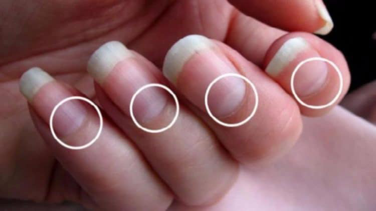 Nhận biết bệnh qua màu sắc móng tay: Nếu móng tay có biểu hiện này, khám ung thư ngay - Ảnh 6.