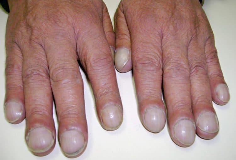 Nhận biết bệnh qua màu sắc móng tay: Nếu móng tay có biểu hiện này, khám ung thư ngay - Ảnh 8.