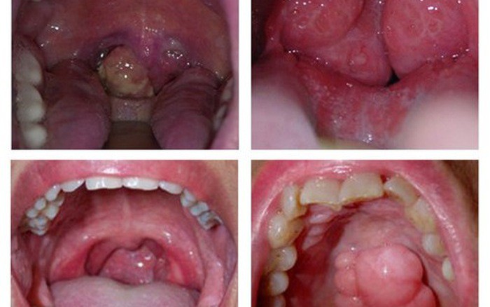 dấu hiệu nhận biết ở từng giai đoạn của ung thư lưỡi