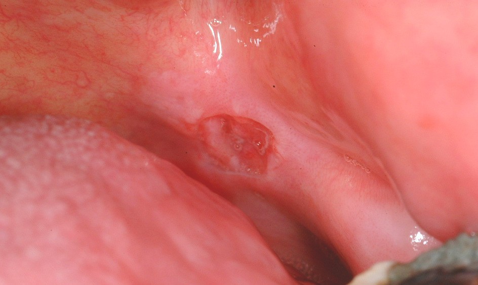 viêm loét miệng - dấu hiệu cảnh báo nhiều bệnh nguy hiểm1
