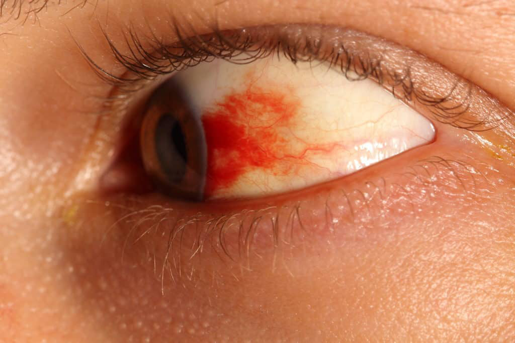 Vỡ mạch máu trong mắt là gì Tìm hiểu chung về bệnh vỡ mạch máu trong mắt 1