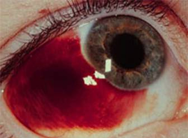 Vỡ mạch máu trong mắt là gì Tìm hiểu chung về bệnh vỡ mạch máu trong mắt 2
