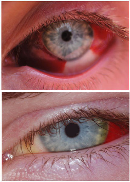 Vỡ mạch máu trong mắt là gì Tìm hiểu chung về bệnh vỡ mạch máu trong mắt 4