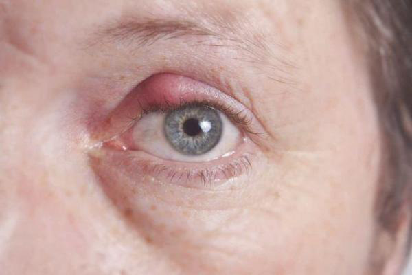 Bệnh lẹo mắt là một căn bệnh không đáng sợ, nhưng còn gây ra khá nhiều phiền toái cho người mắc. Hãy xem hình ảnh liên quan để hiểu rõ hơn về căn bệnh này và cách phòng tránh.