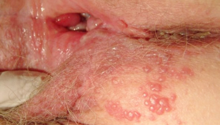 Tìm hiểu tổng quan về chứng bệnh Herpes sinh dục-1